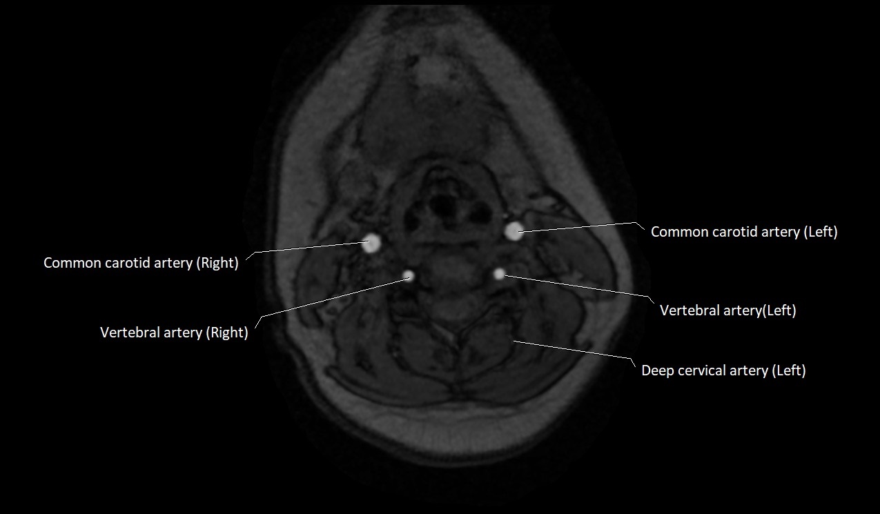 Carotid artery anatomy axial 3T image 33.jpg